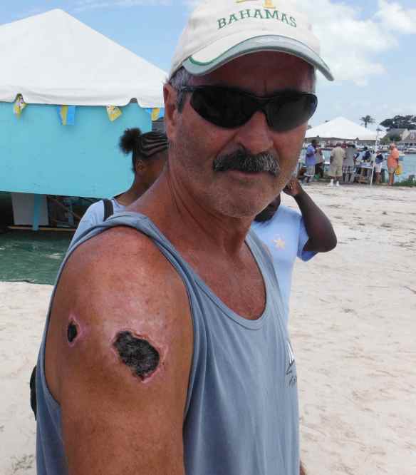 Another cruiser that was stung by a lion fish.